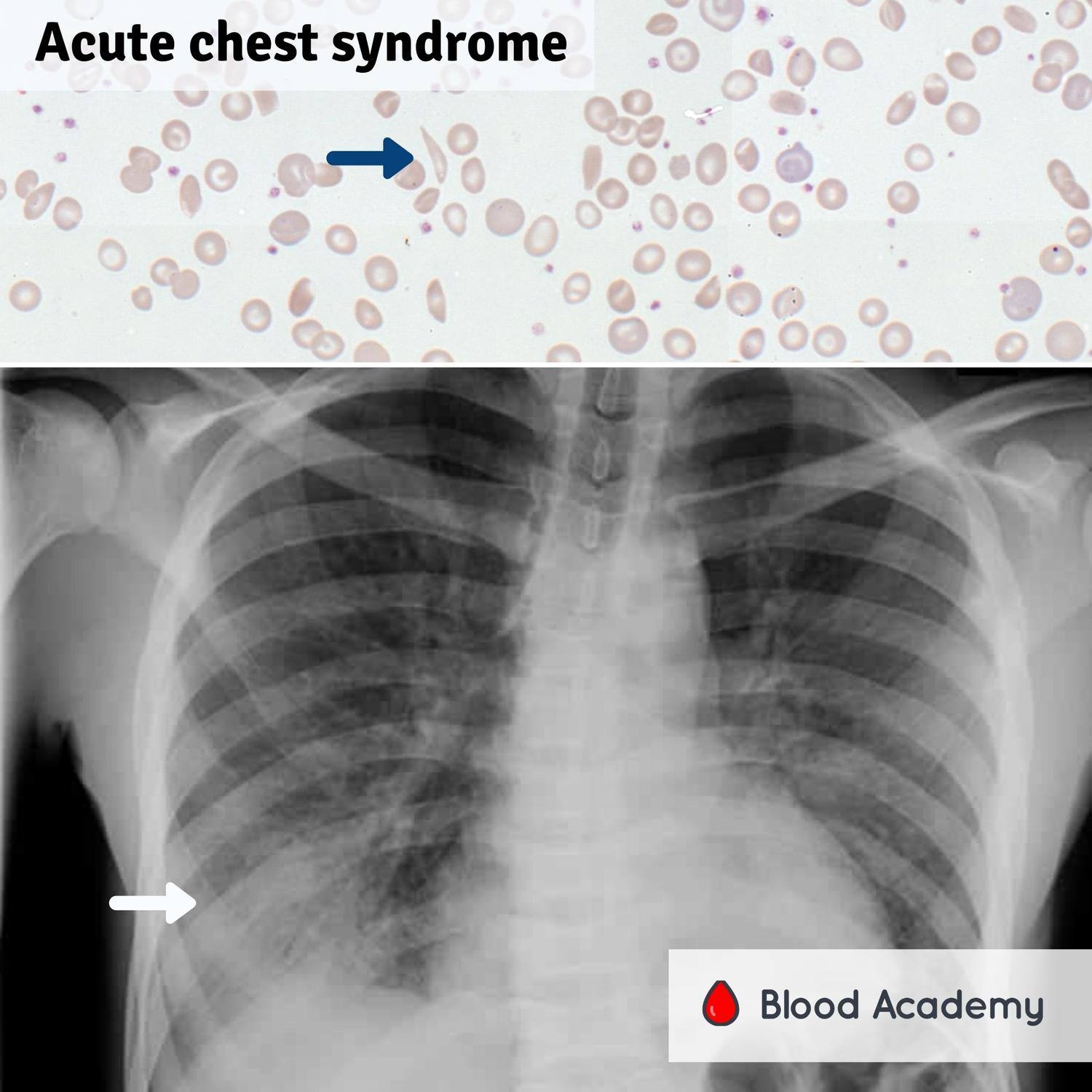 acute-chest-syndrome-acs-blood-academy