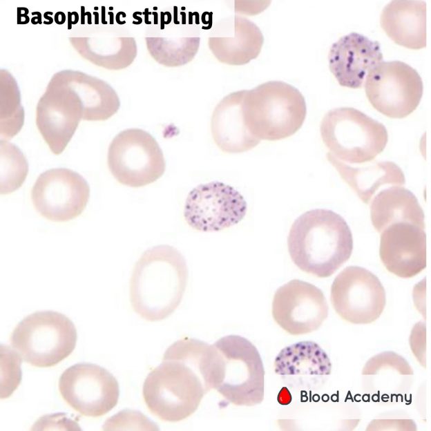 Basophilic stippling (also known as punctate basophilia) - Blood Academy