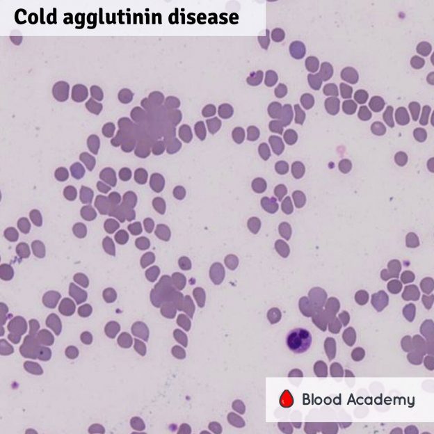 Cold agglutinin disease - Blood Academy