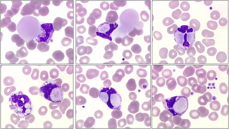 Cryoglobulinaemia - Blood Academy