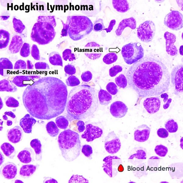 Hodgkin lymphoma – Blood Academy