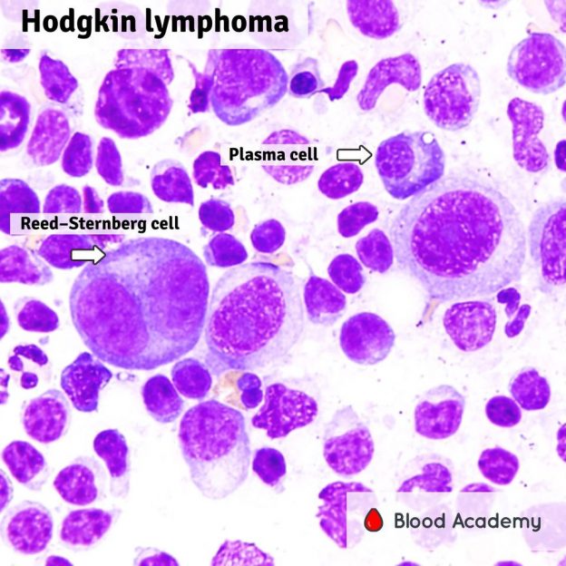 hodgkin-lymphoma-blood-academy